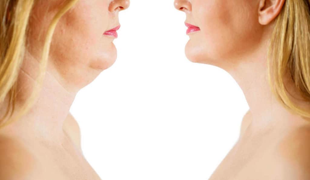 Double Chin treatment South Yardley before and after results