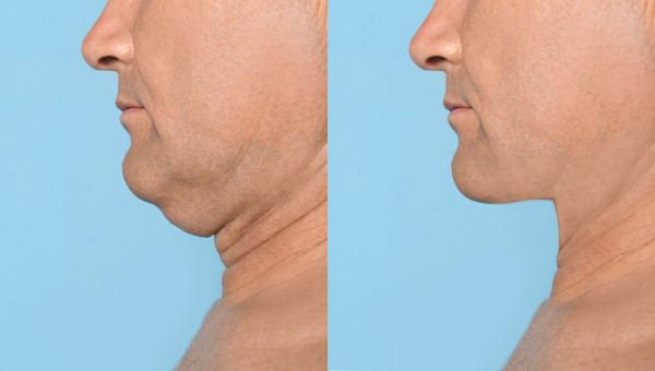 Which Non-Surgical Treatments Work Best for Jowls and Loose Skin South Yardley?