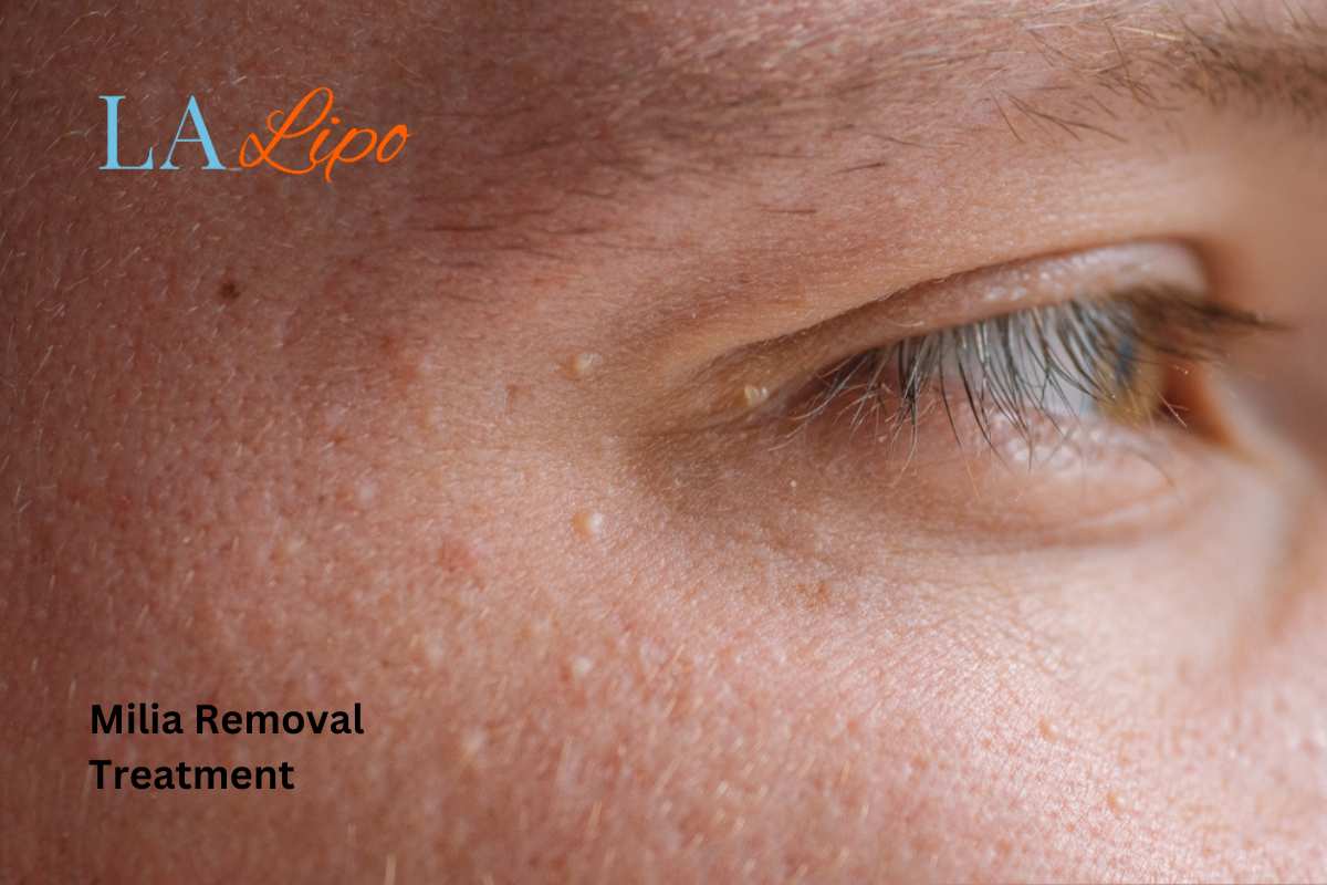 Cryopen Milia Removal: Is It the Easiest and Safest Option South Yardley?
