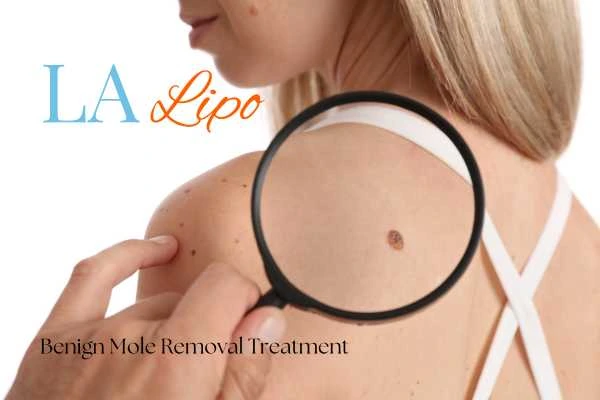 Why getting moles removed South Yardley can boost your confidence!