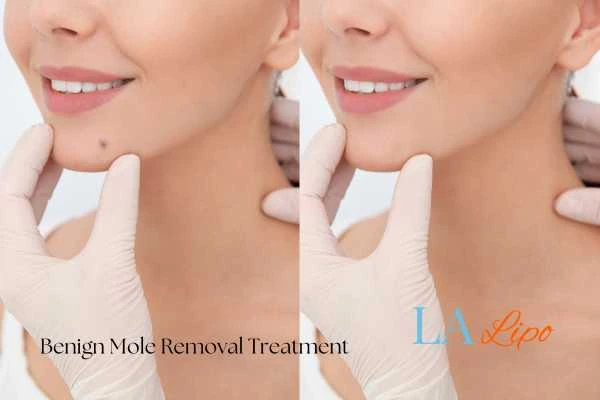 Woman's before and after results of being moles removal treatment South Yardley