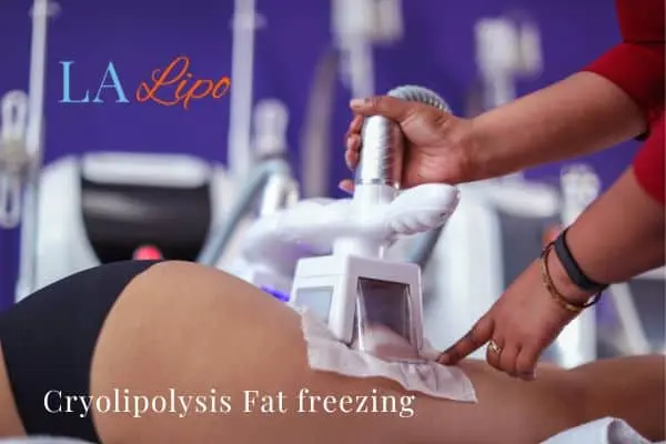 women getting fat freezing South Yardley