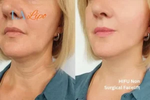 hi-fu for wrinkles South Yardley before and after results