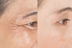 Before and after results of woman - HI-fu wrinkles reduction treatment South Yardley