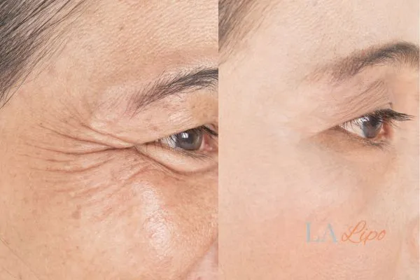 Before and after results of woman - HI-fu wrinkles reduction treatment South Yardley