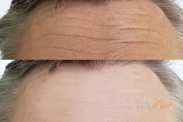 results of HIFU South Yardley on mans forehead to help reduce lines and wrinkles