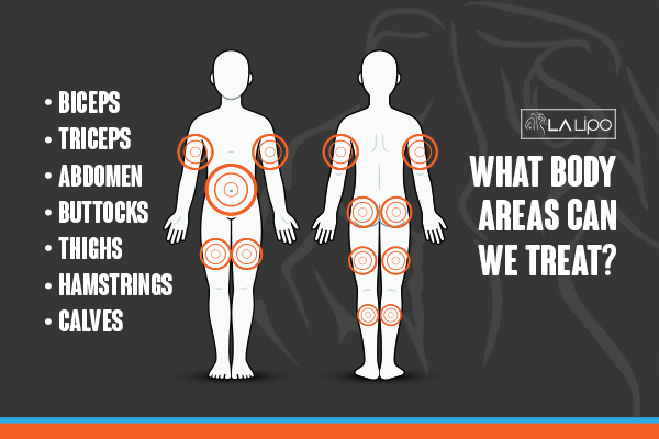 Graphic to show areas you can have LA-EMS Body Sculpting South Yardley treatment.