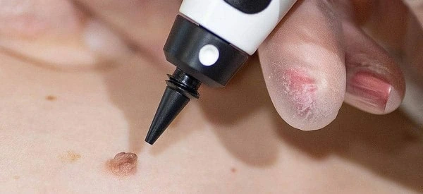skin tag removal using cryopen South Yardley