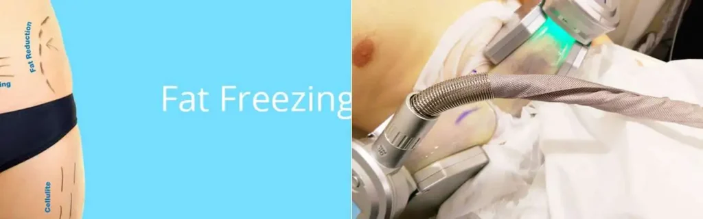 multi areas of a persons body having coolsculpting South Yardley treatment