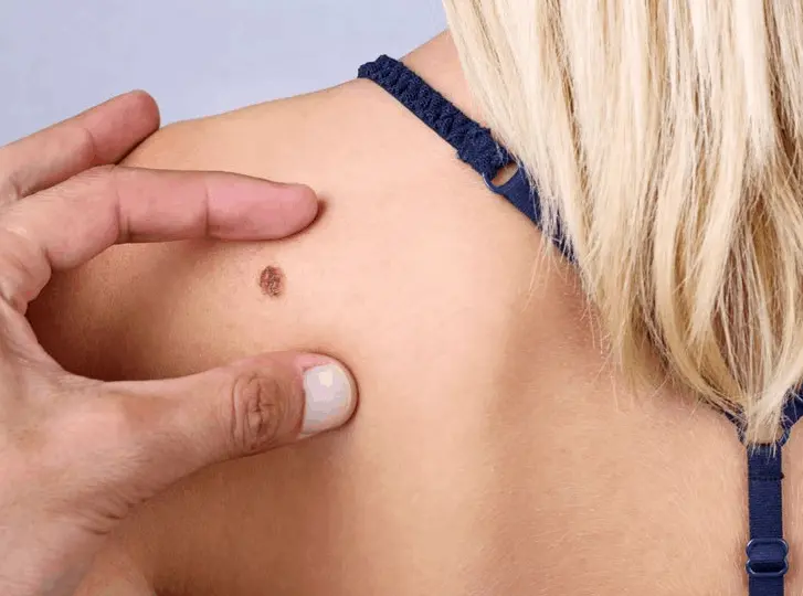 woman having mole removal South Yardley consultation before treatment.
