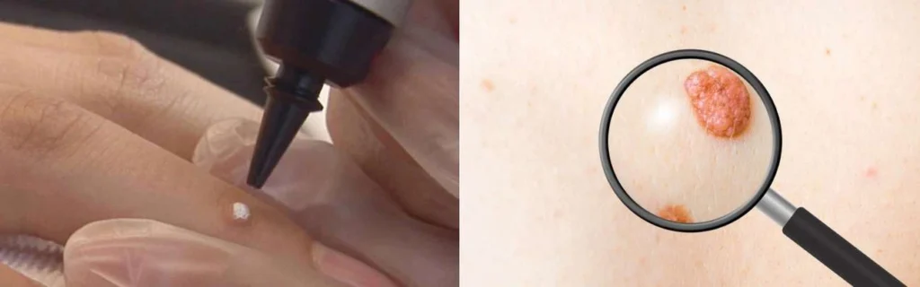 Person getting moles removed with cryopen South Yardley