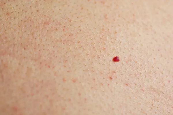 close up of a cherry angioma South Yardley
