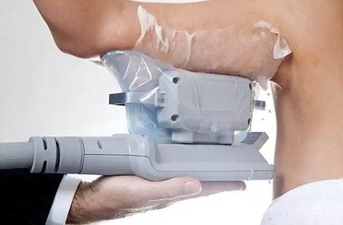 Picture of fat freezing South Yardley on the upper arms.