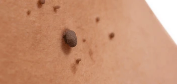 image of a skin tag South Yardley