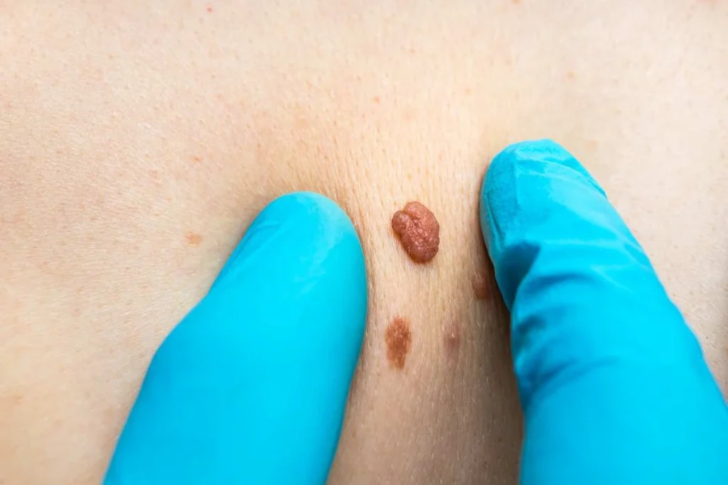 Consultant examining a skin tag South Yardley