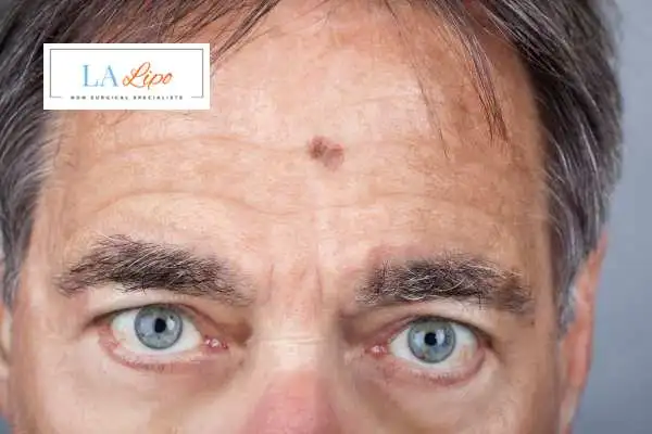 Solar Lentigo Removal South Yardley image of man with mark on his forehead