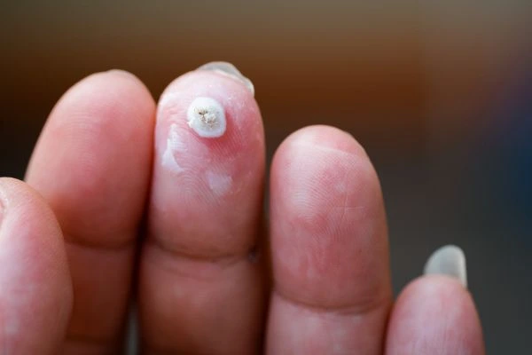 wart on person finger - cryotherapy to treat from LA LIPO South Yardley