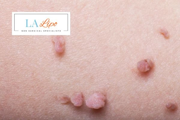 Does cryopen skin tag removal South Yardley hurt? Find out now call our team today!