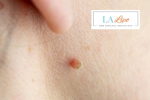 Book skin tag removal South Yardley today speak to our team now!