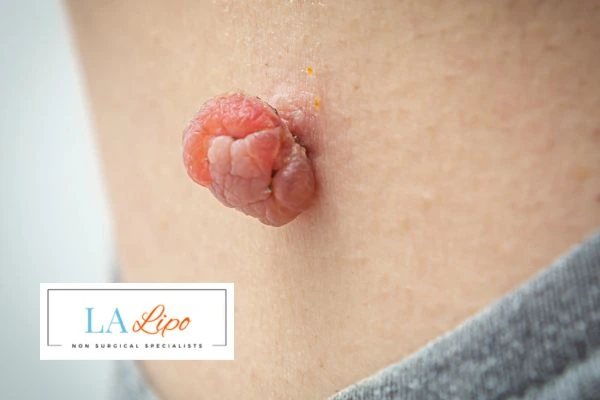 Interested in skin tag removal South Yardley? Concerned about the pain? Find out more today!