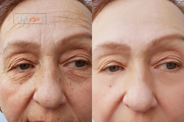 The powerful benefits of Morpheus8 Treatment South Yardley - Call Our team today!