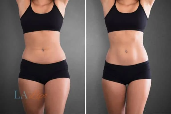 before and after results of non-surgical treatment to help a woman's body image and mental health South Yardley