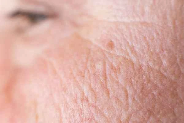 close up picture of a woman's face showing an age spot South Yardley