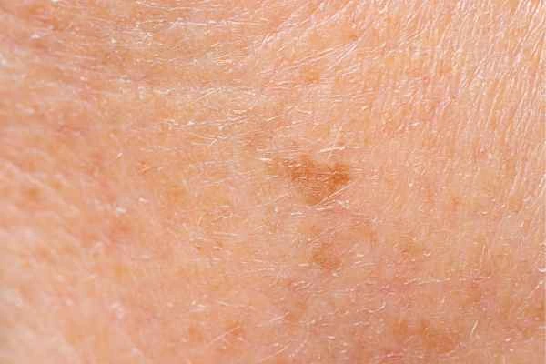 close up picture of age spots South Yardley