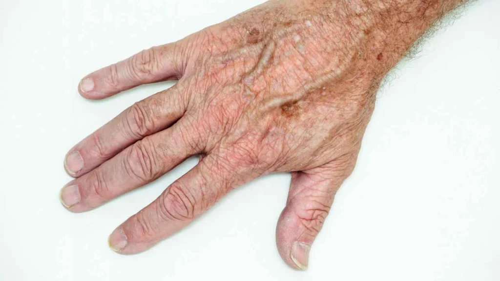 Male hand showing age spot South Yardley