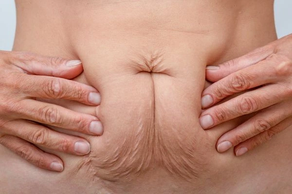 Image of a woman's stomach with loose skin - example of skin tightening South Yardley options