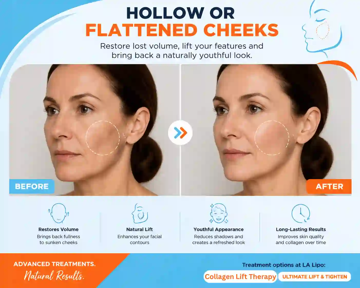 Sign #4: Hollow or Flattened Cheeks South Yardley