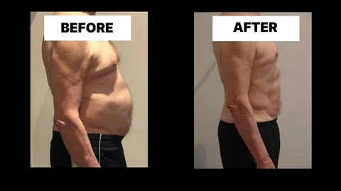 What Symptoms Can Diastasis Recti Cause in Men? Weak Core, Back Pain and Poor Posture South Yardley